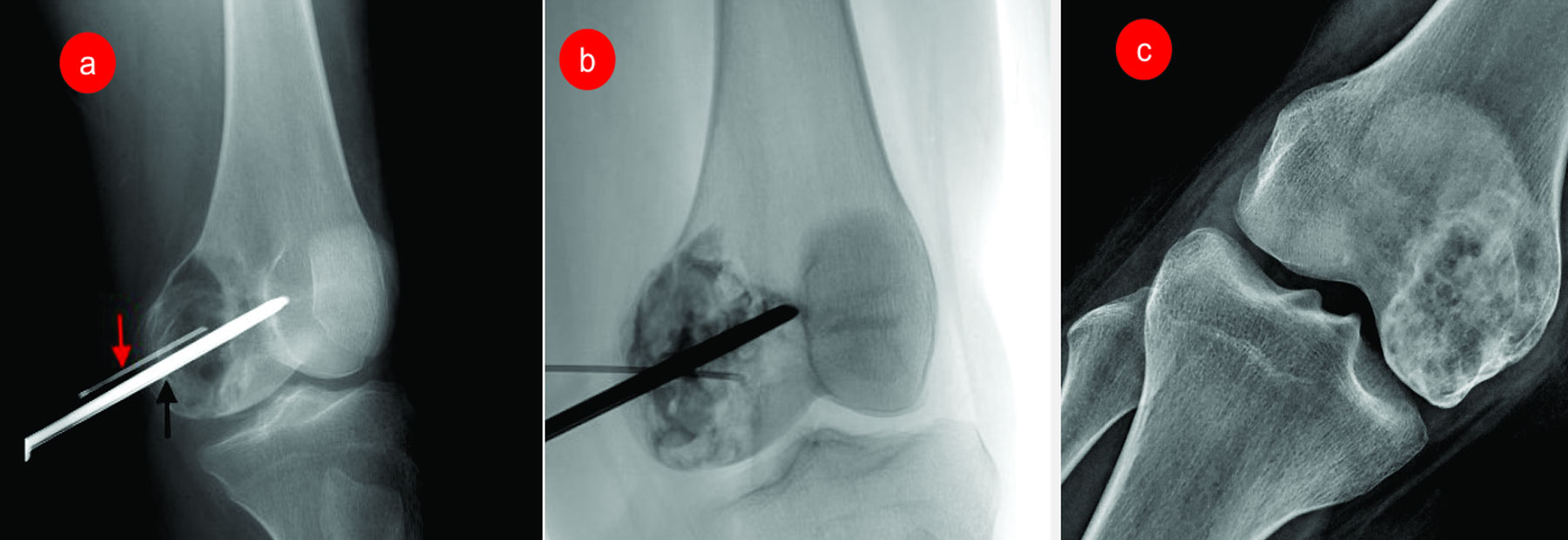 Bone Cancer Hospital